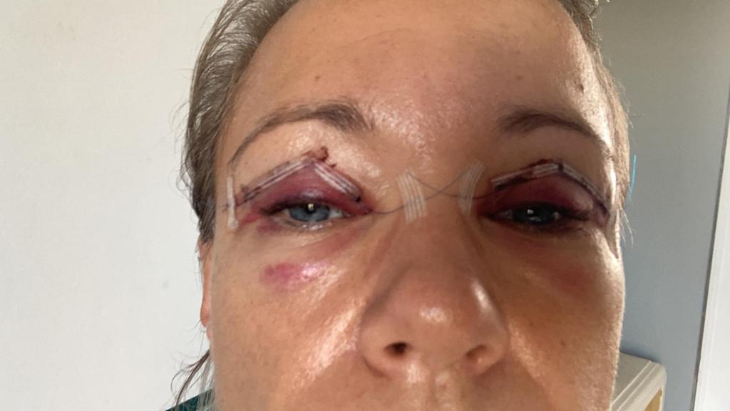 ooglidcorrectie gent genezing 1 dag