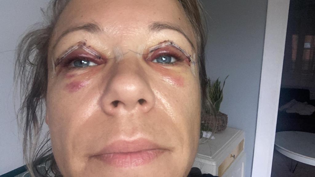 ooglidcorrectie gent genezing 3 dagen